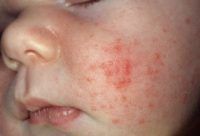 acne bij babygezicht
