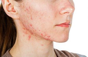 acne op vrouwelijk gezicht 