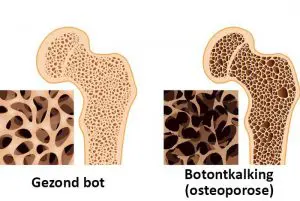 osteoporose vs. gezond bot
