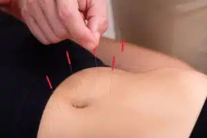 afvallen buikstreek acupunctuur