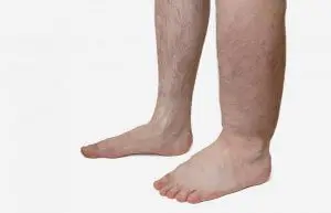 jambe normale et jambe avec rétention d'eau