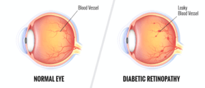 Oogproblemen bij diabetici wordt diabetische retinopathie genoemd.