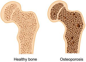 gezonde botten versus osteoporose