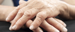 close-up van vrouwenhand met artrose of reuma