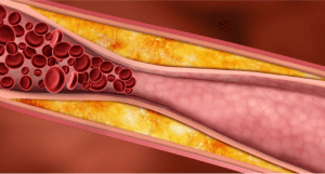 illustratie van cholesterol dat de blauwvaten nauwer maakt 