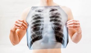 tuberculose op röntgenfoto