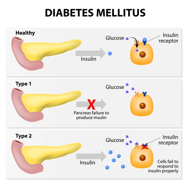 illustratie van insuline en diabetes type 2